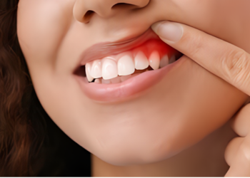 Khi răng sứ trở thành mối lo: Nguy cơ viêm nhiễm từ phục hình không đạt chuẩn