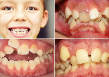 8 nguyên nhân khiến răng mọc lệch ai cũng cần biết